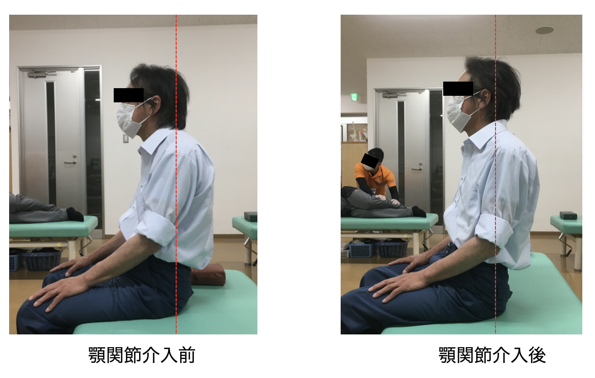 頚部や肩・肩甲帯の疼痛や機能障害は顎関節の影響かも? 〜理学療法士が解説する「隠れ顎関節症」と全身の関係〜