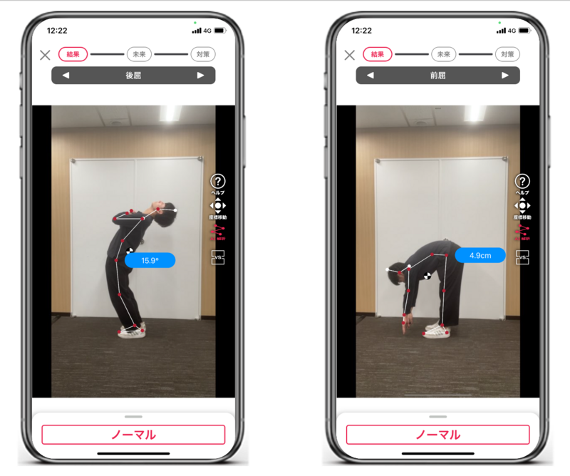 腰部屈曲時に背側から下肢に症状が出現する患者の評価・治療の実際(全２枚) 腰部⑪：屈曲型疼痛評価・伸展型疼痛評価（5点セット） – RehaArt