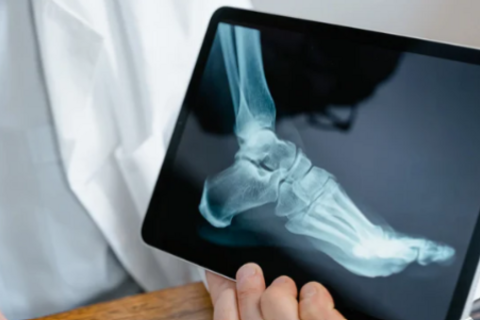 歩行動作のための足部・足関節の評価・リハビリテーション